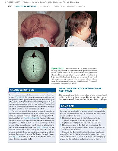 Before We Are Born: Essentials of Embryology and Birth Defects,Used