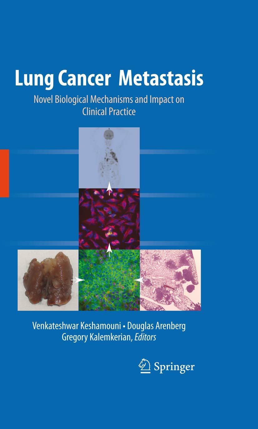 Lung Cancer Metastasis: Novel Biological Mechanisms and Impact on Clinical Practice,Used
