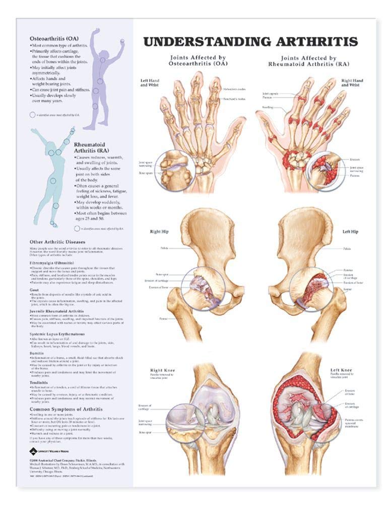 Understanding Arthritis Anatomical Chart,New