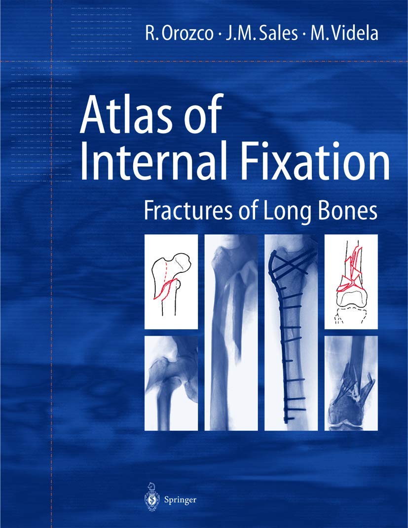 Atlas of Internal Fixation: Fractures of Long Bones,Used