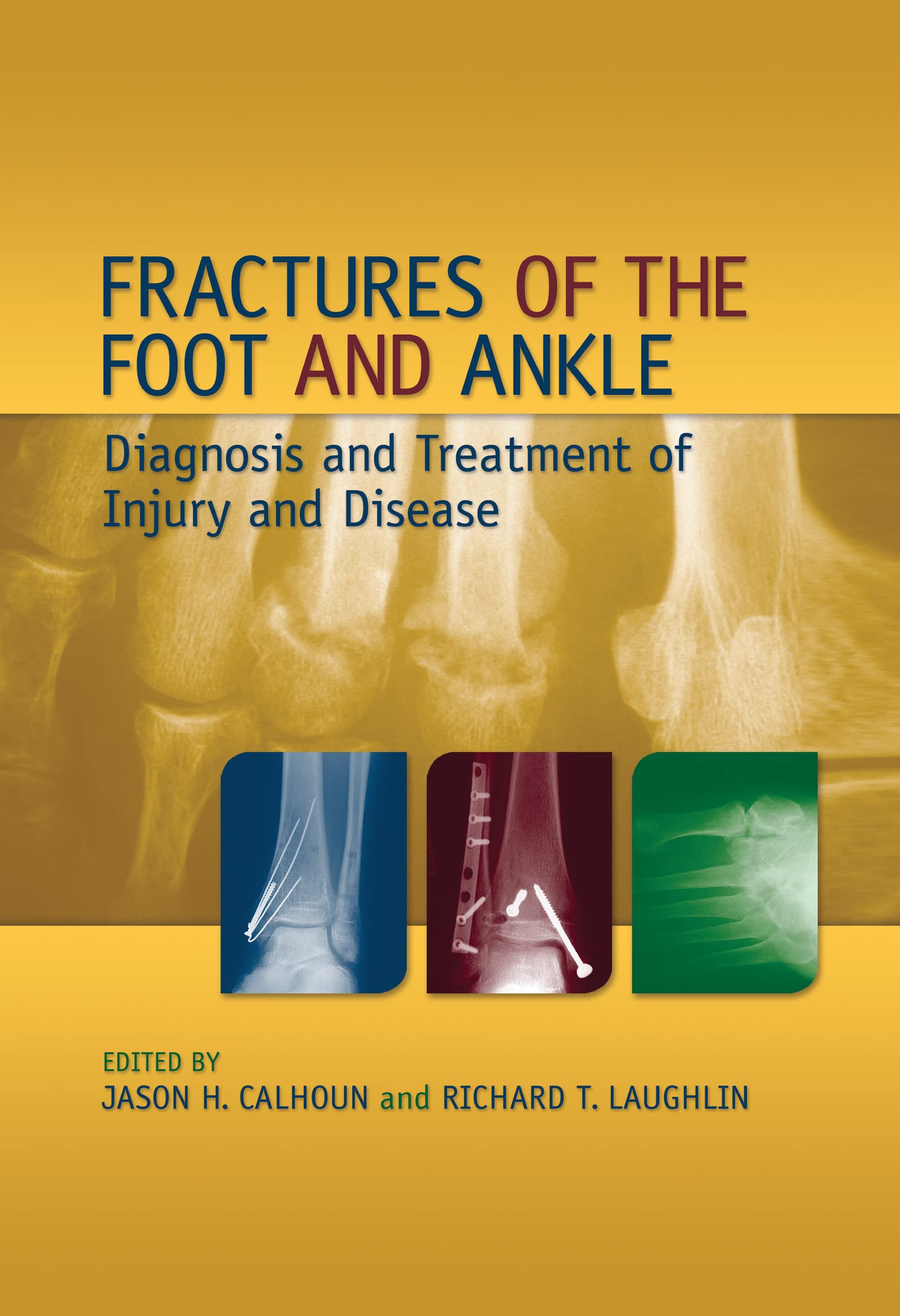 Fractures of the Foot and Ankle: Diagnosis and Treatment of Injury and Disease,Used
