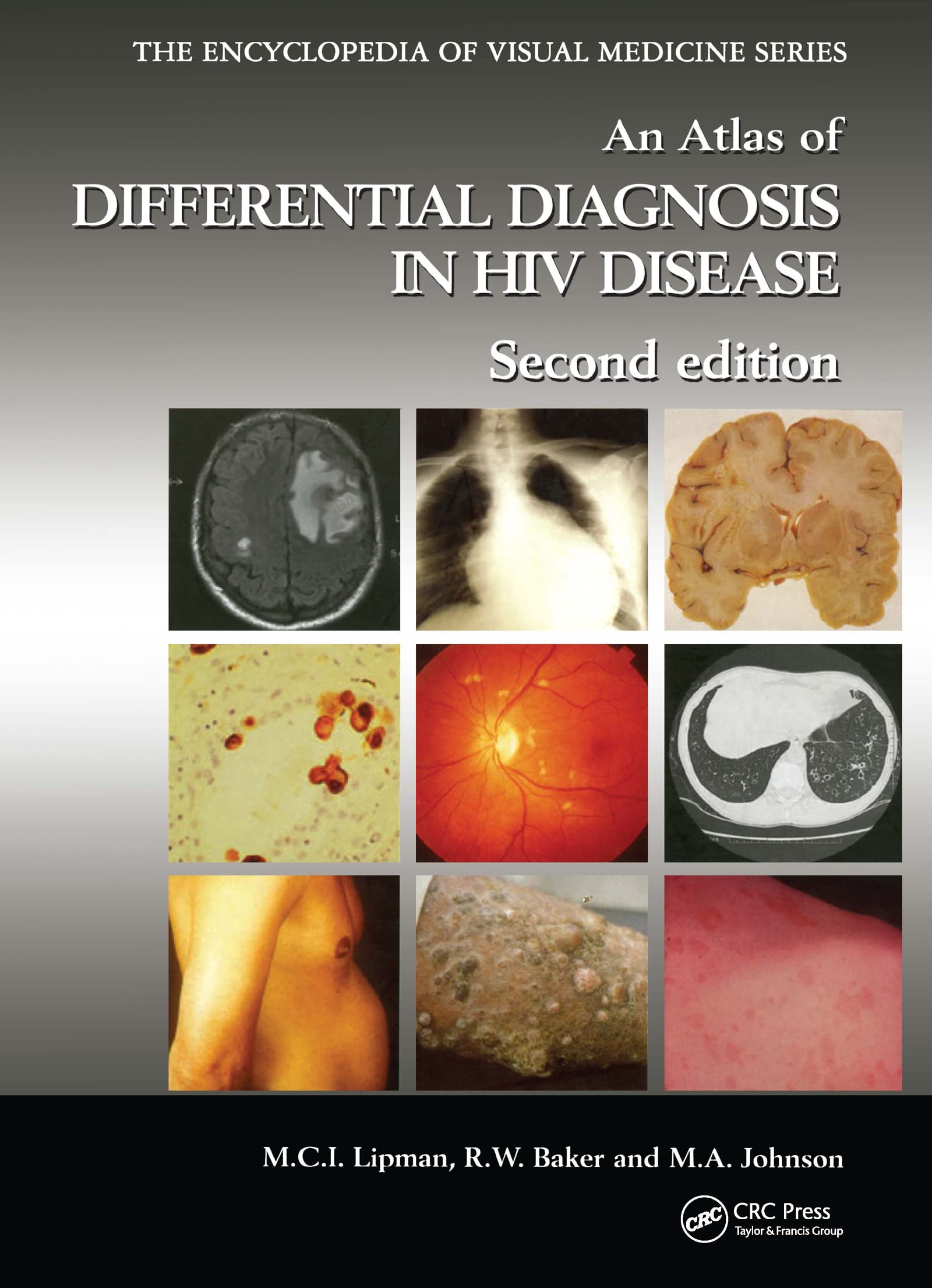 An Atlas of Differential Diagnosis in HIV Disease (Encyclopedia of Visual Medicine Series),Used