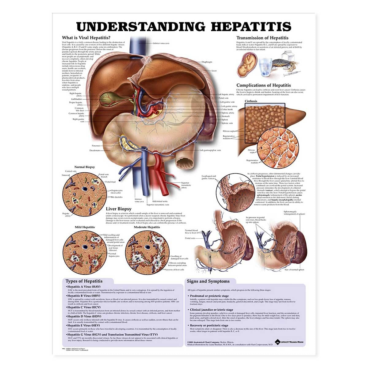 Understanding Hepatitis Anatomical Chart,Used