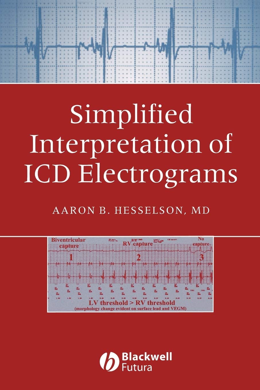 Simplified Interpretation of ICD Electrograms,Used