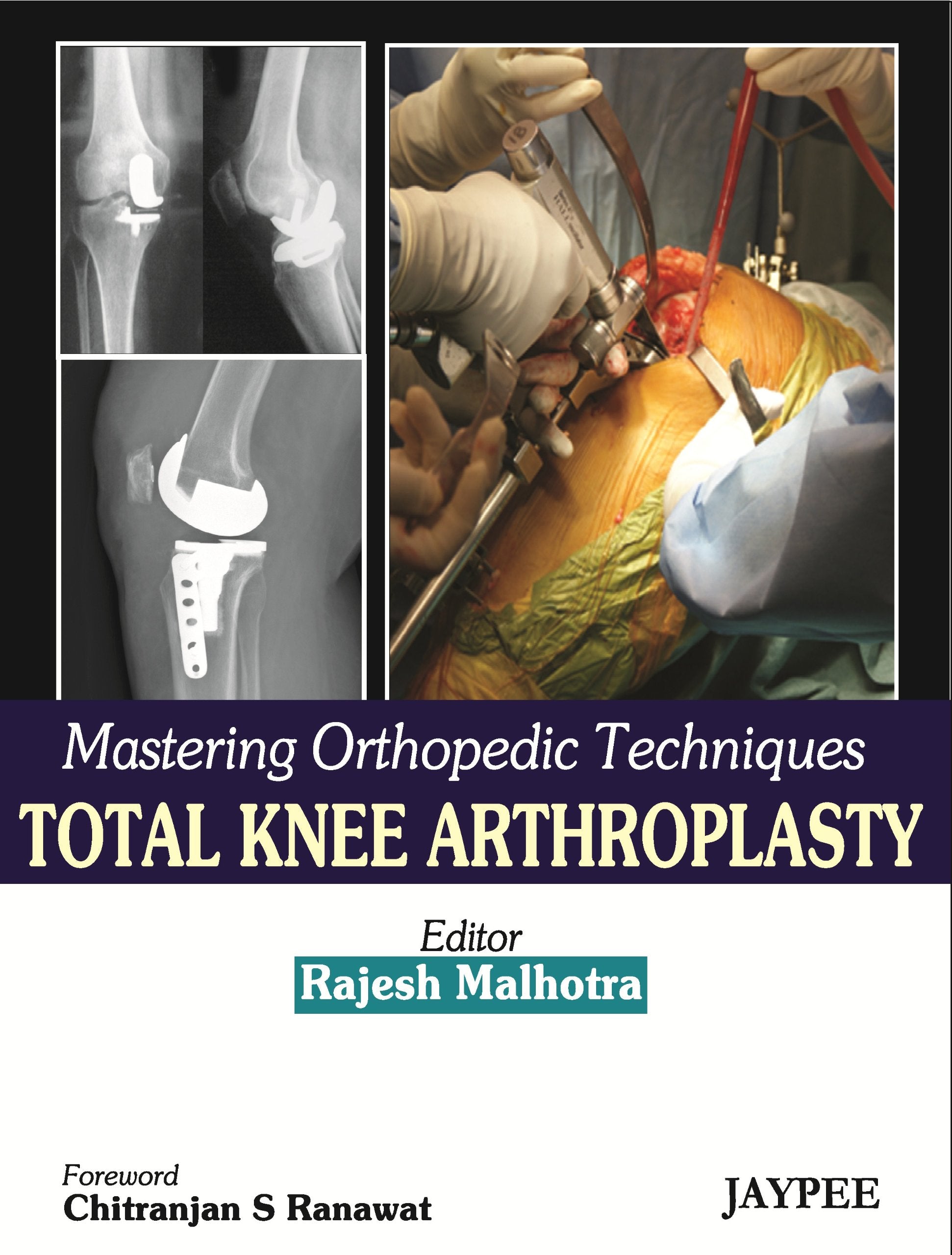 Mastering Orthopedic Techniques Total Knee Arthroplasty,Used