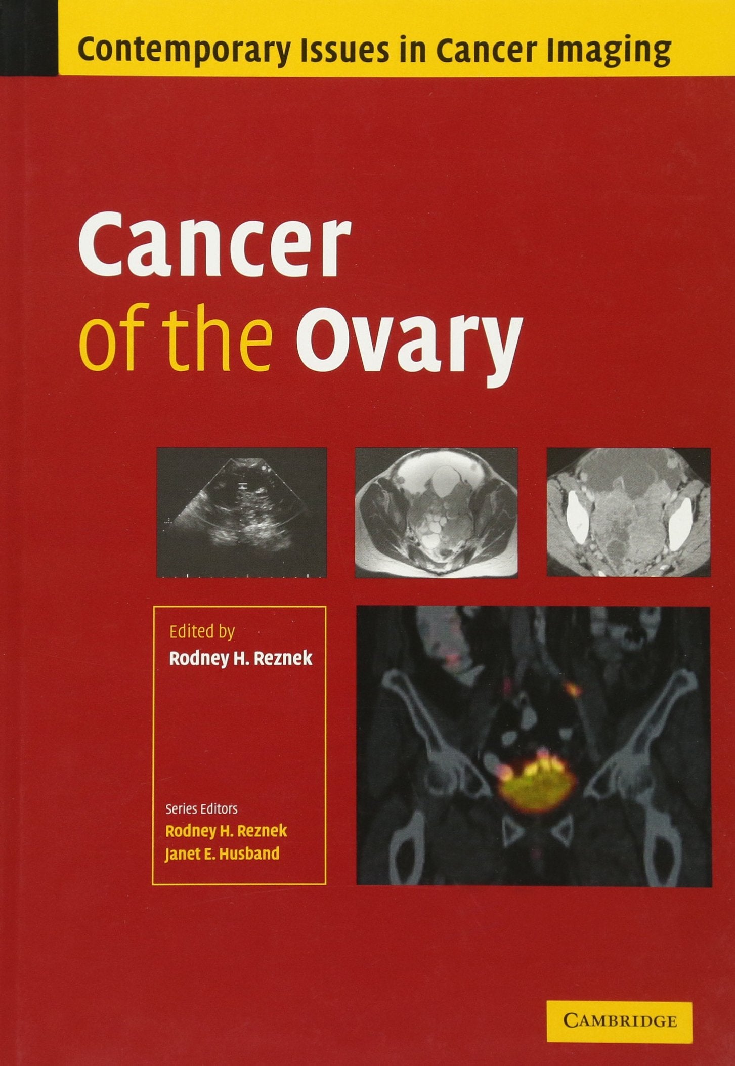 Cancer of the Ovary (Contemporary Issues in Cancer Imaging),Used