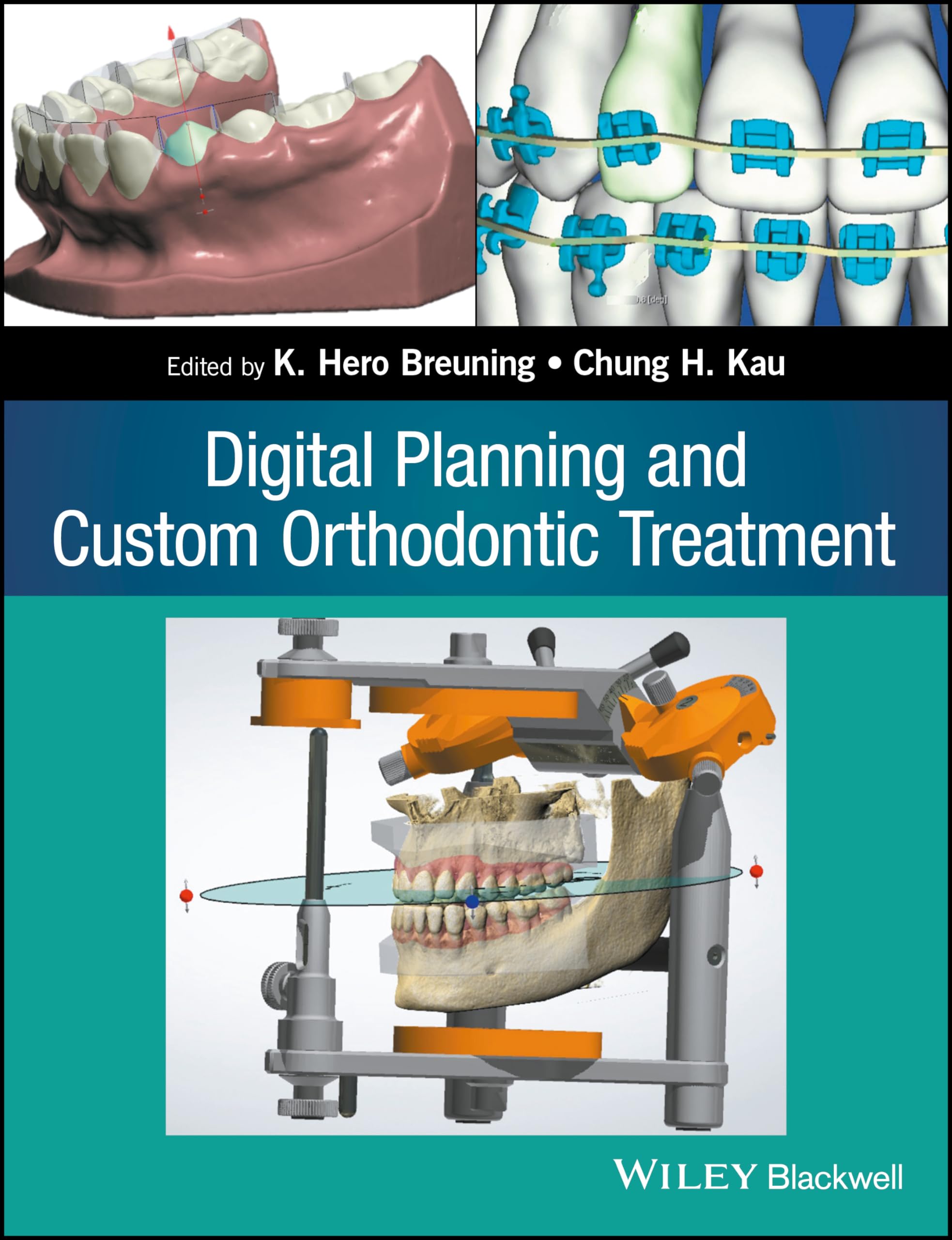 Digital Planning and Custom Orthodontic Treatment,Used