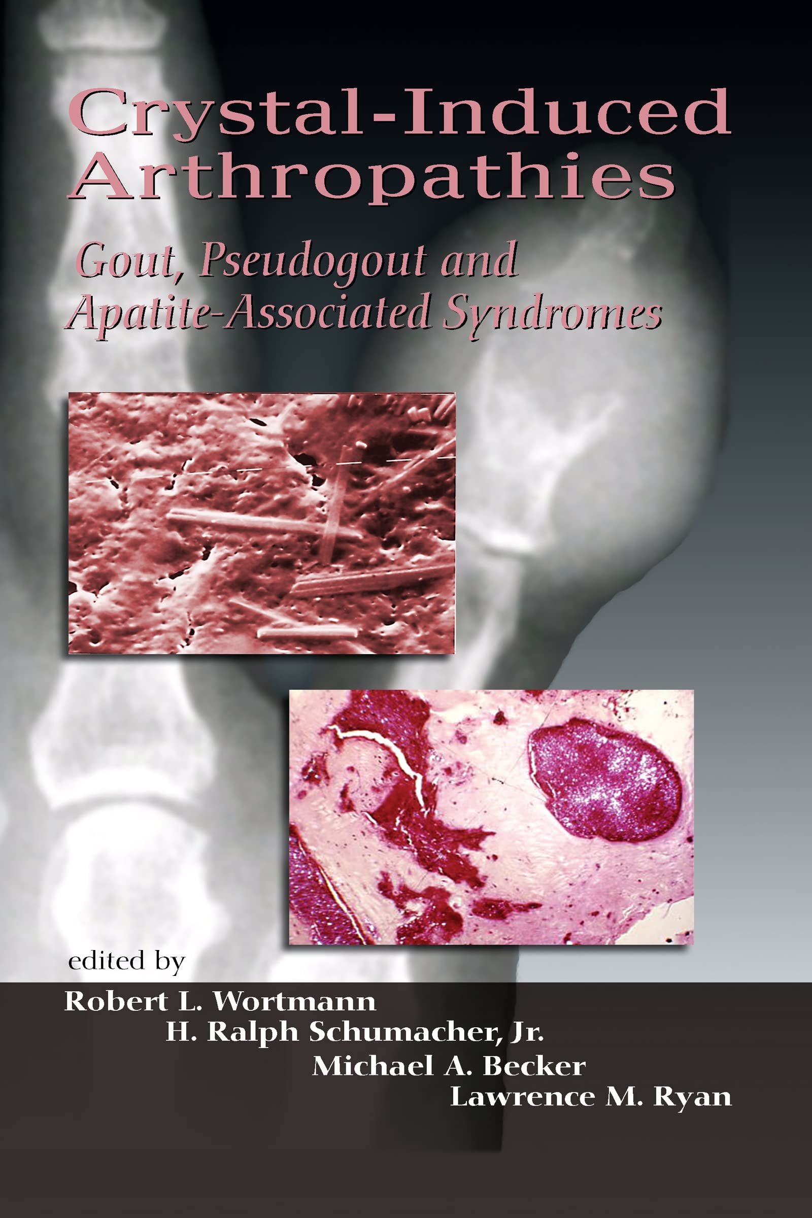 Crystalinduced Arthropathies,Used