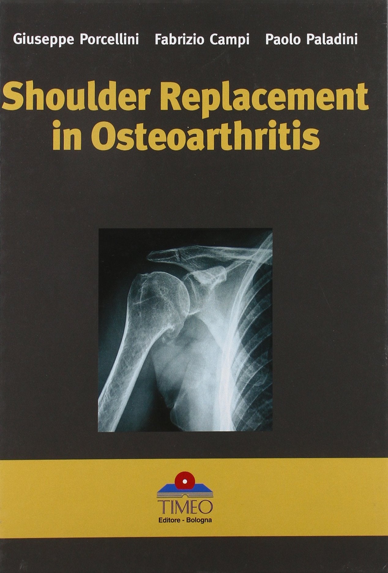 Shoulder Replacement in Osteoarthritis,Used