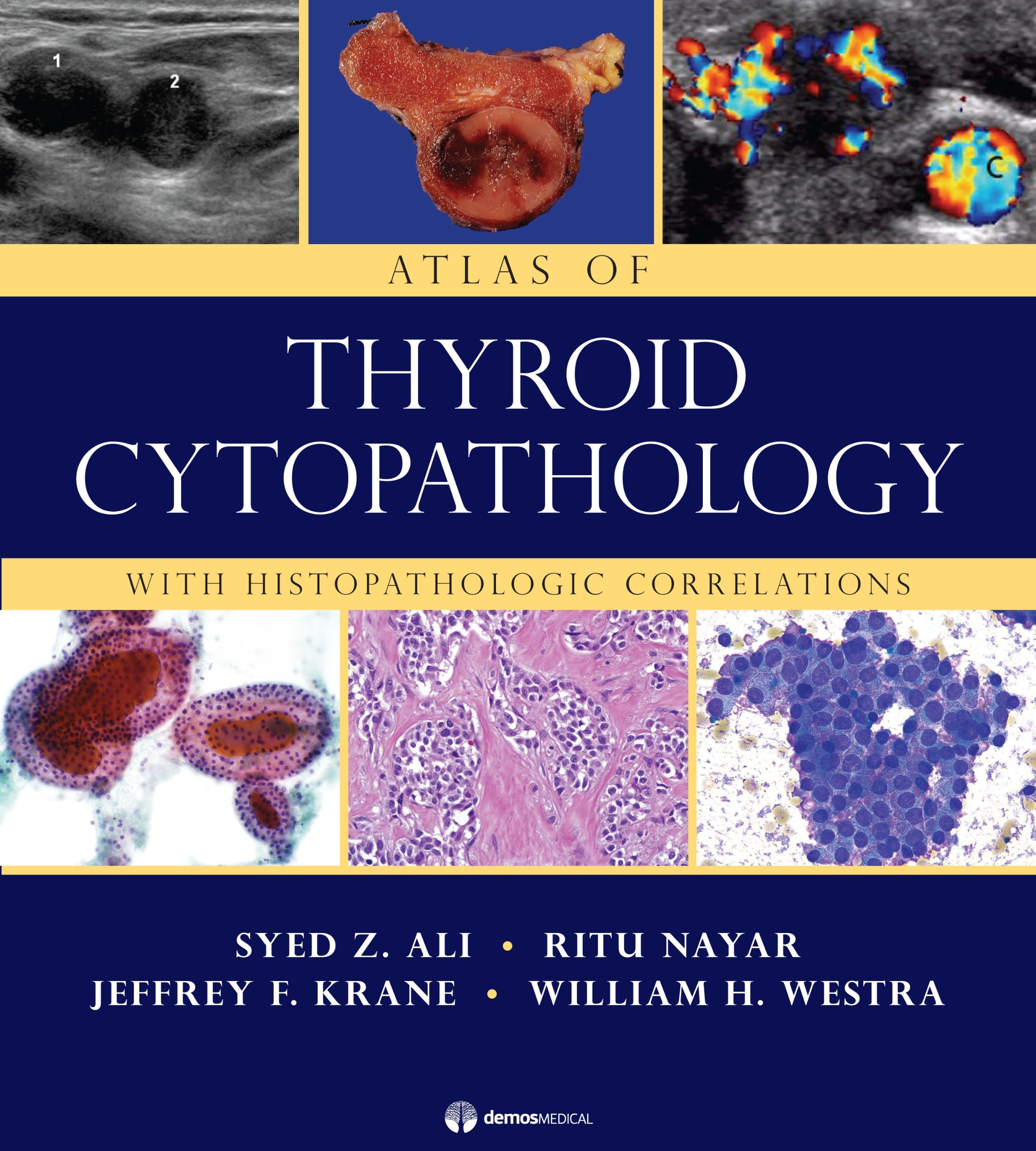 Atlas of Thyroid Cytopathology: With Histopathologic Correlations,Used