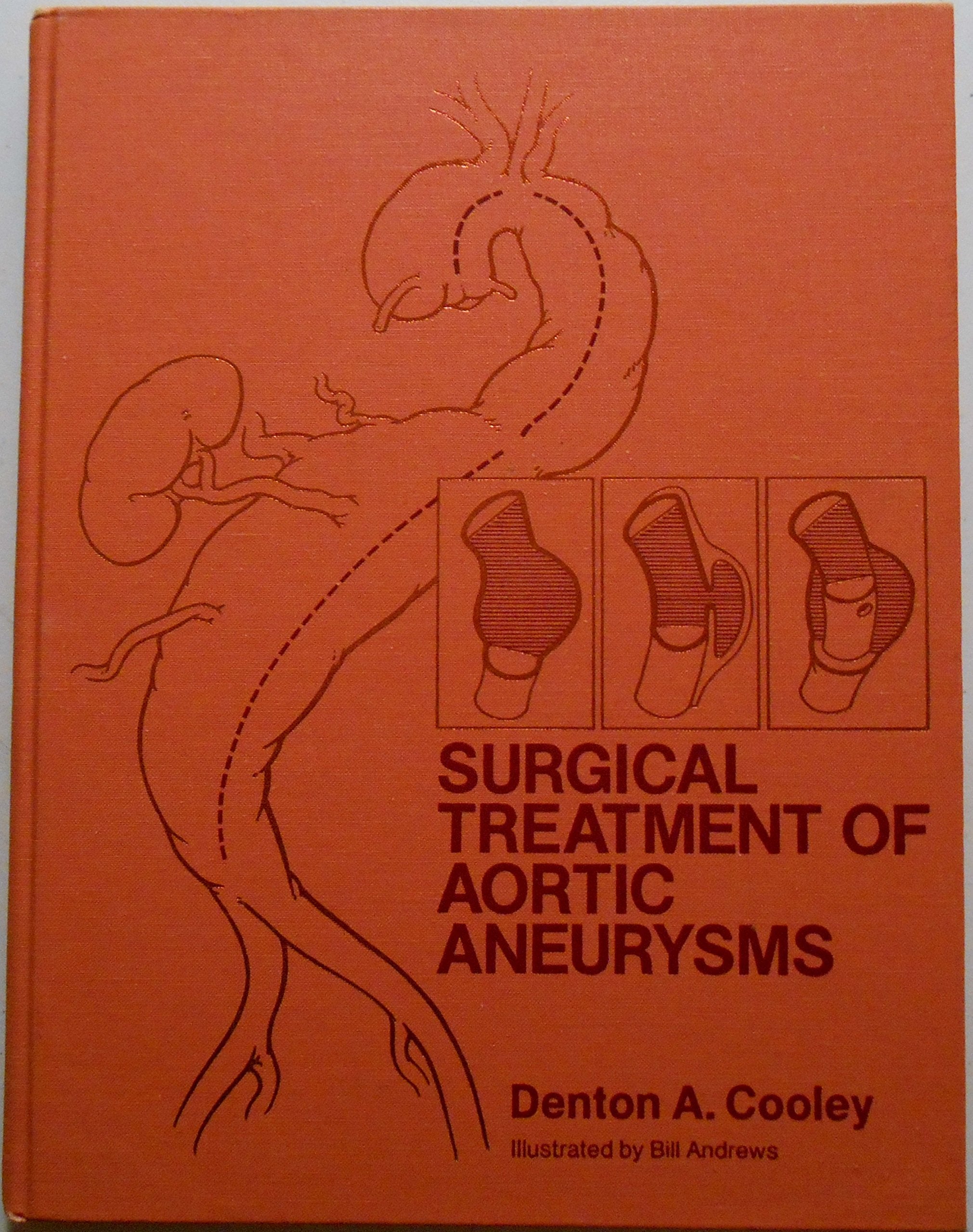Surgical Treatment of Aortic Aneurysms,Used