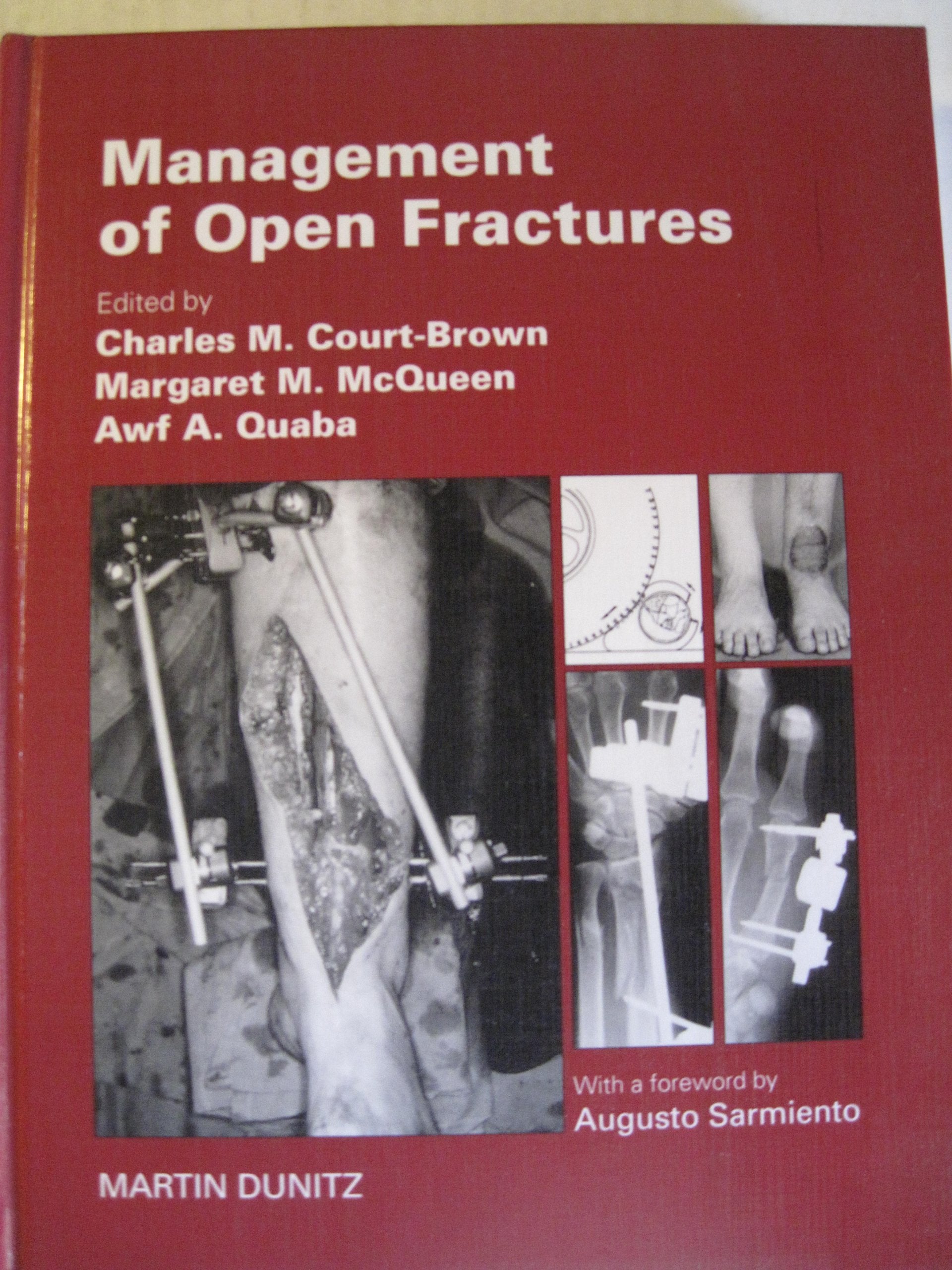 Management of Open Fractures,Used