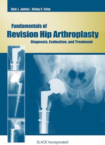 Fundamentals of Revision Hip Arthroplasty: Diagnosis, Evaluation, and Treatment,Used