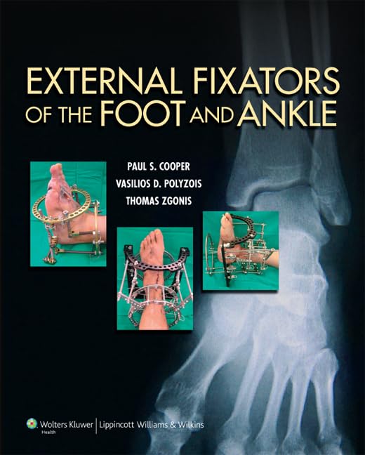 External Fixators of the Foot and Ankle,Used