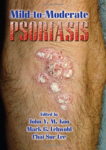Mildtomoderate Psoriasis,Used