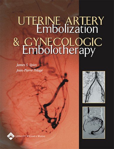 Uterine Artery Embolization And Gynecologic Embolotherapy,Used