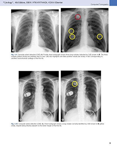 Imaging Of Diseases Of The Chest: Expert Consult  Online And Print