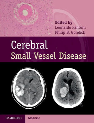 Cerebral Small Vessel Disease,Used