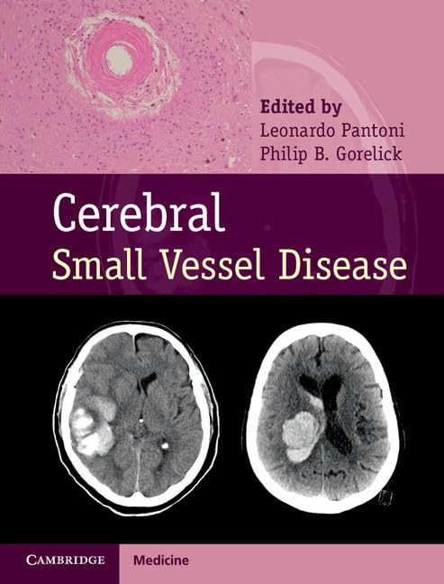 Cerebral Small Vessel Disease,Used