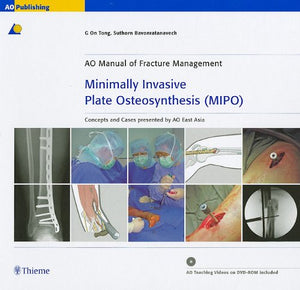 Minimally Invasive Plate Osteosynthesis (MIPO): Concepts and cases presented by the AO East Asia,Used