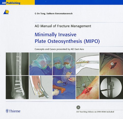 Minimally Invasive Plate Osteosynthesis (MIPO): Concepts and cases presented by the AO East Asia,Used