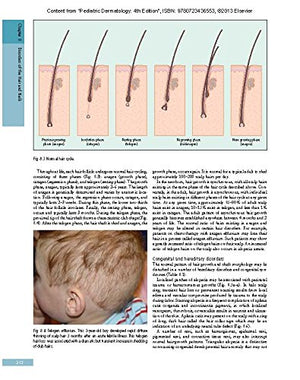 Pediatric Dermatology: Expert Consult  Online and Print (Cohen, Pediatric Dermatology),Used