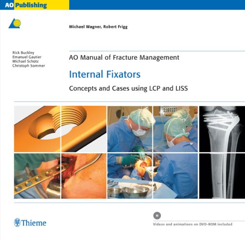 Internal Fixators: Concepts and Cases Using Lcp and Liss (Ao Manual of Fracture Management Series),Used