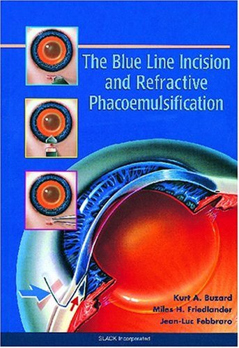 The Blue Line Incision and Refractive Phacoemulsification,Used