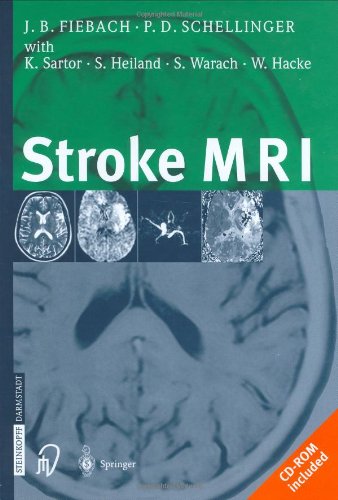 Stroke MRI,Used