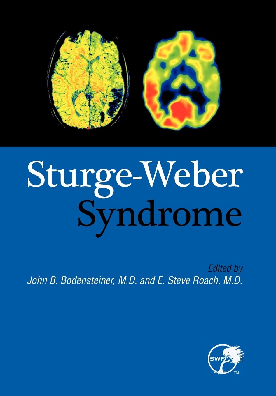 SturgeWeber Syndrome,Used
