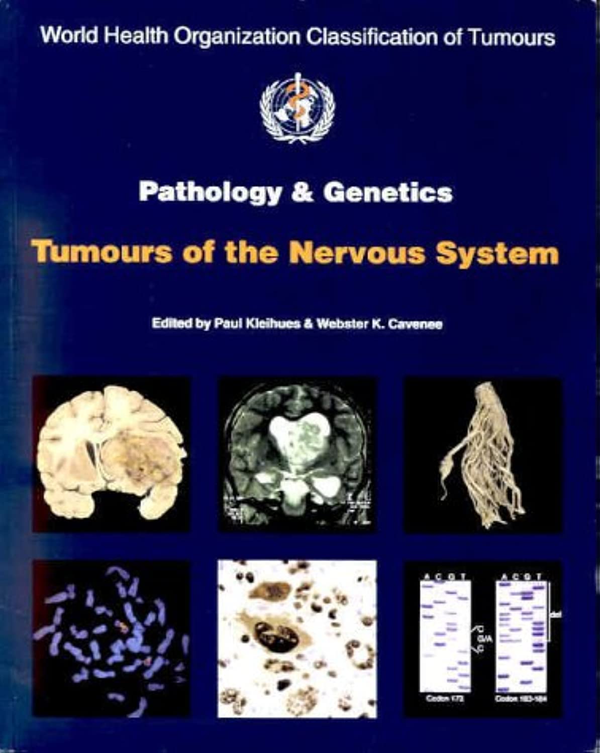 World Health Organization Classification Of Tumours: Pathology And Genetics: Tumours Of The Nervous System,Used