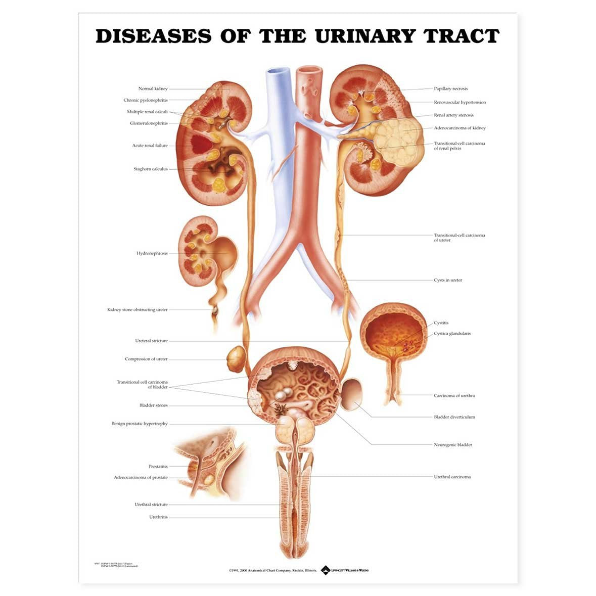 Diseases of the Urinary Tract Anatomical Chart,New