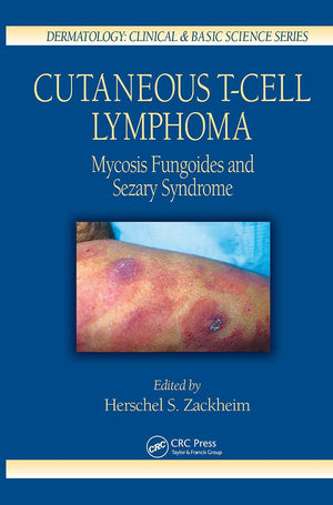 Cutaneous TCell Lymphoma: Mycosis Fungoides and Sezary Syndrome (Dermatology: Clinical & Basic Science, 26),Used