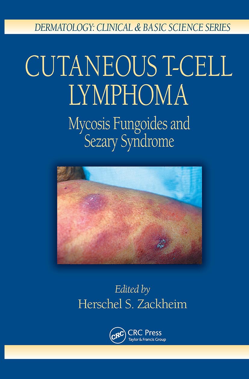 Cutaneous TCell Lymphoma: Mycosis Fungoides and Sezary Syndrome (Dermatology: Clinical & Basic Science, 26),Used