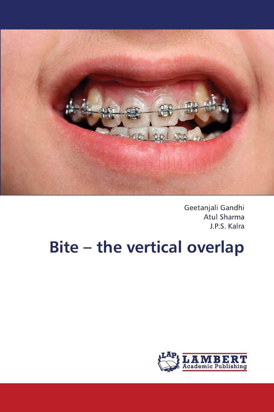 Bite  the vertical overlap,Used