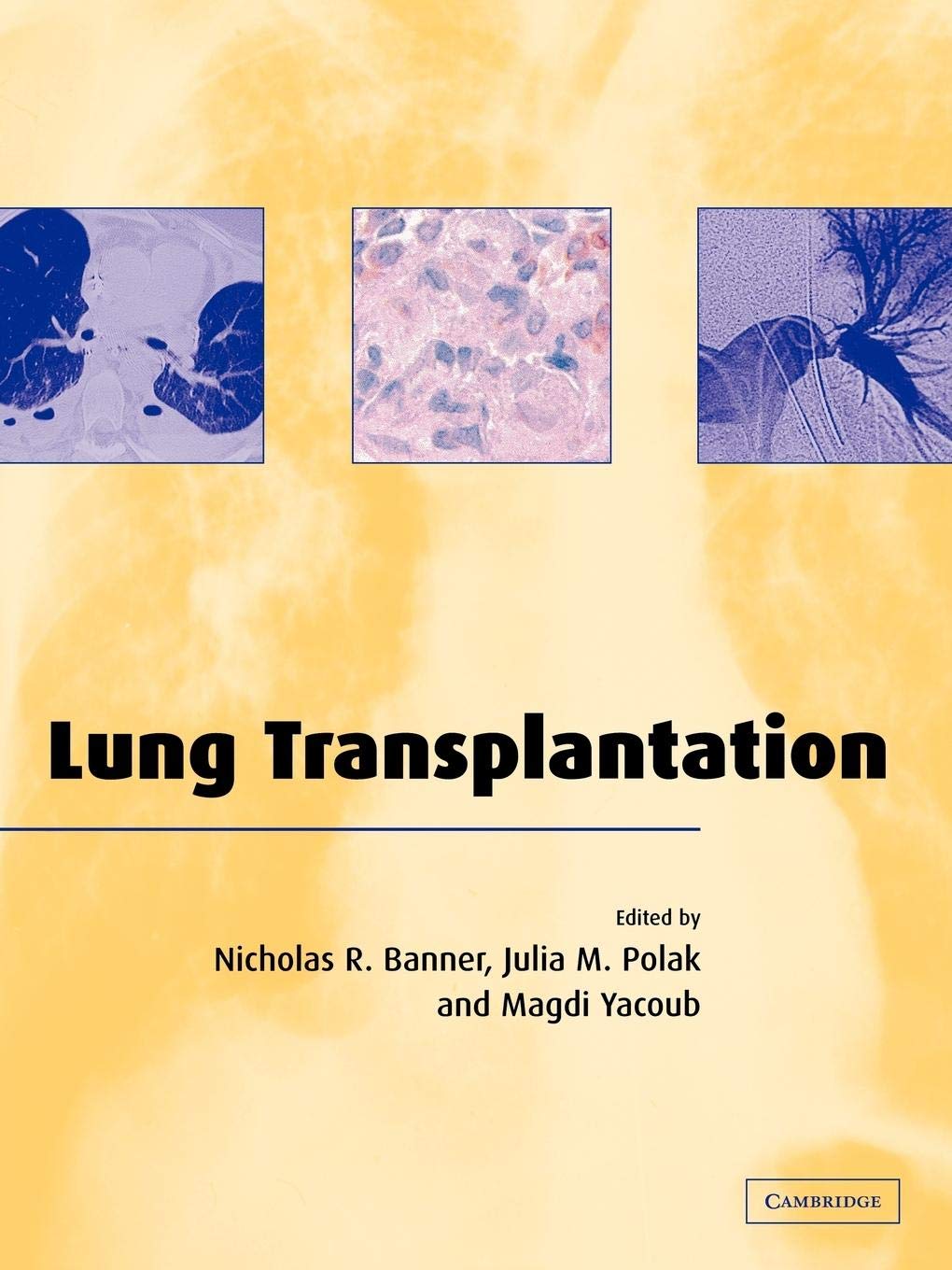 Lung Transplantation,Used