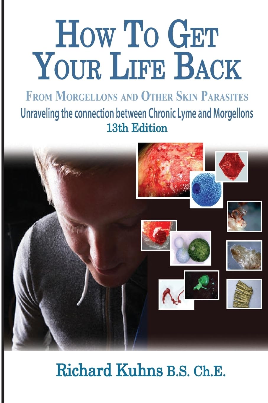 How To Get Your Life Back From Morgellons And Other Skin Parasites Limited Edit
