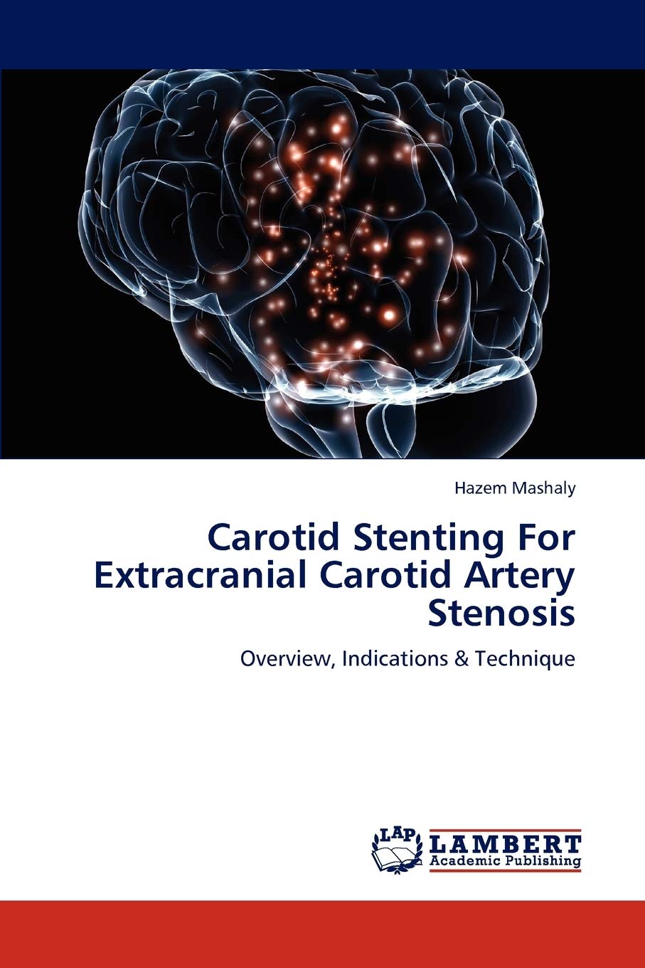 Carotid Stenting For Extracranial Carotid Artery Stenosis: Overview, Indications & Technique,Used