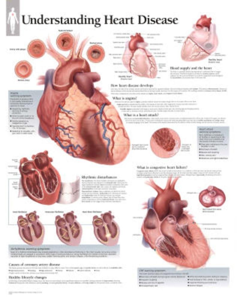 Understanding Heart Disease chart: Laminated Wall Chart,New
