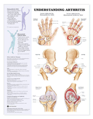 Understanding Arthritis Anatomical Chart,New