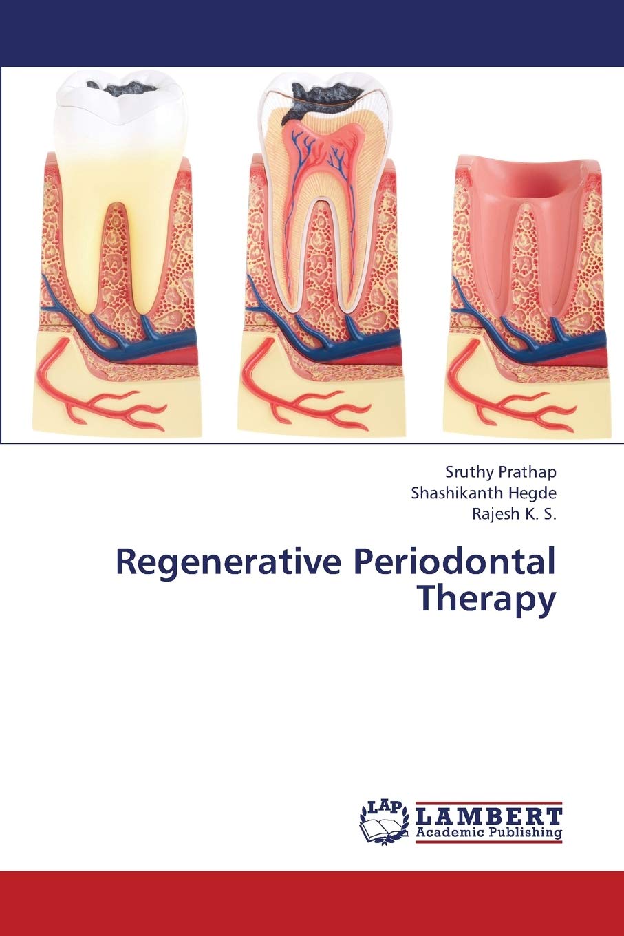 Regenerative Periodontal Therapy,Used