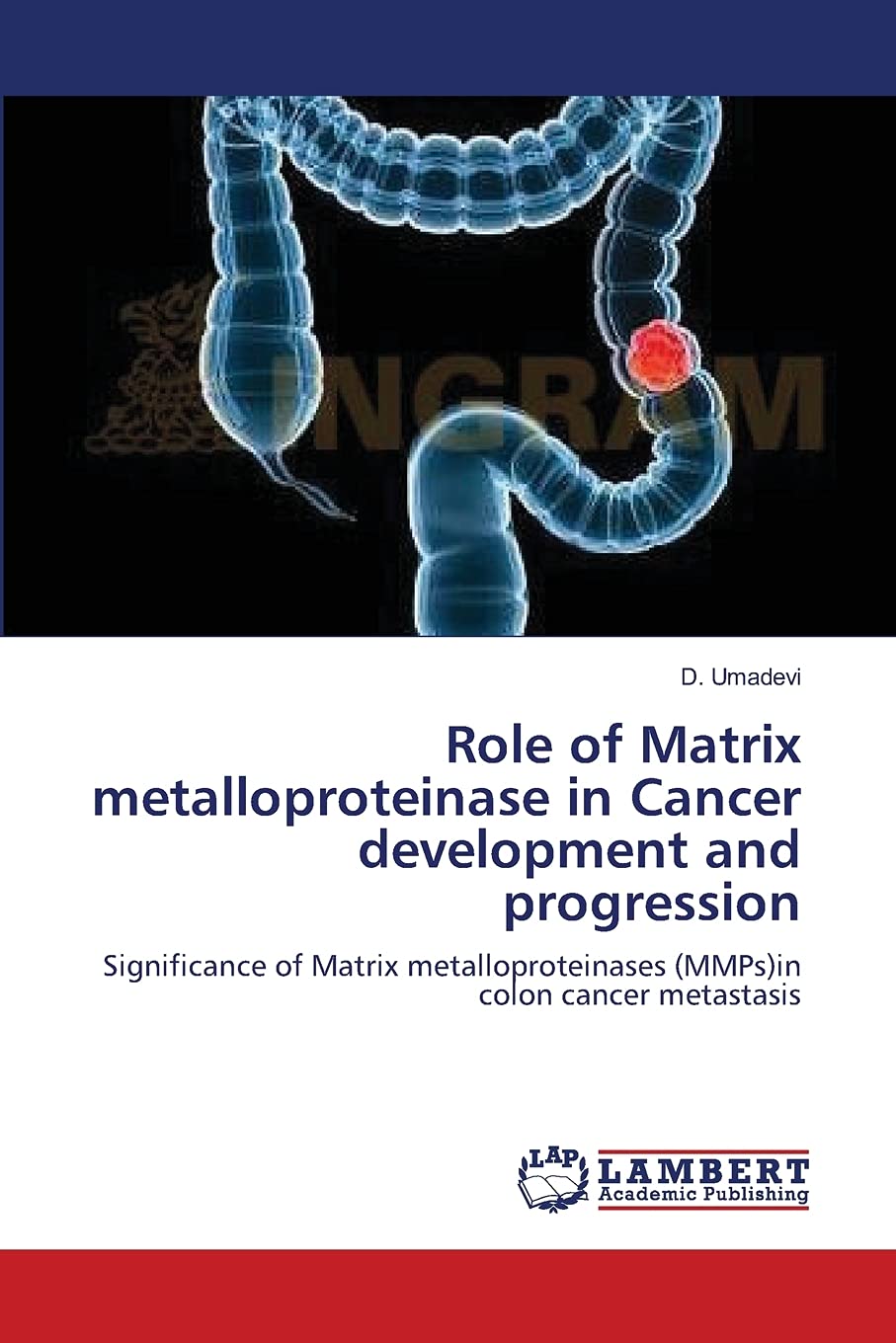 Role of Matrix metalloproteinase in Cancer development and progression: Significance of Matrix metalloproteinases (MMPs)in colon,Used