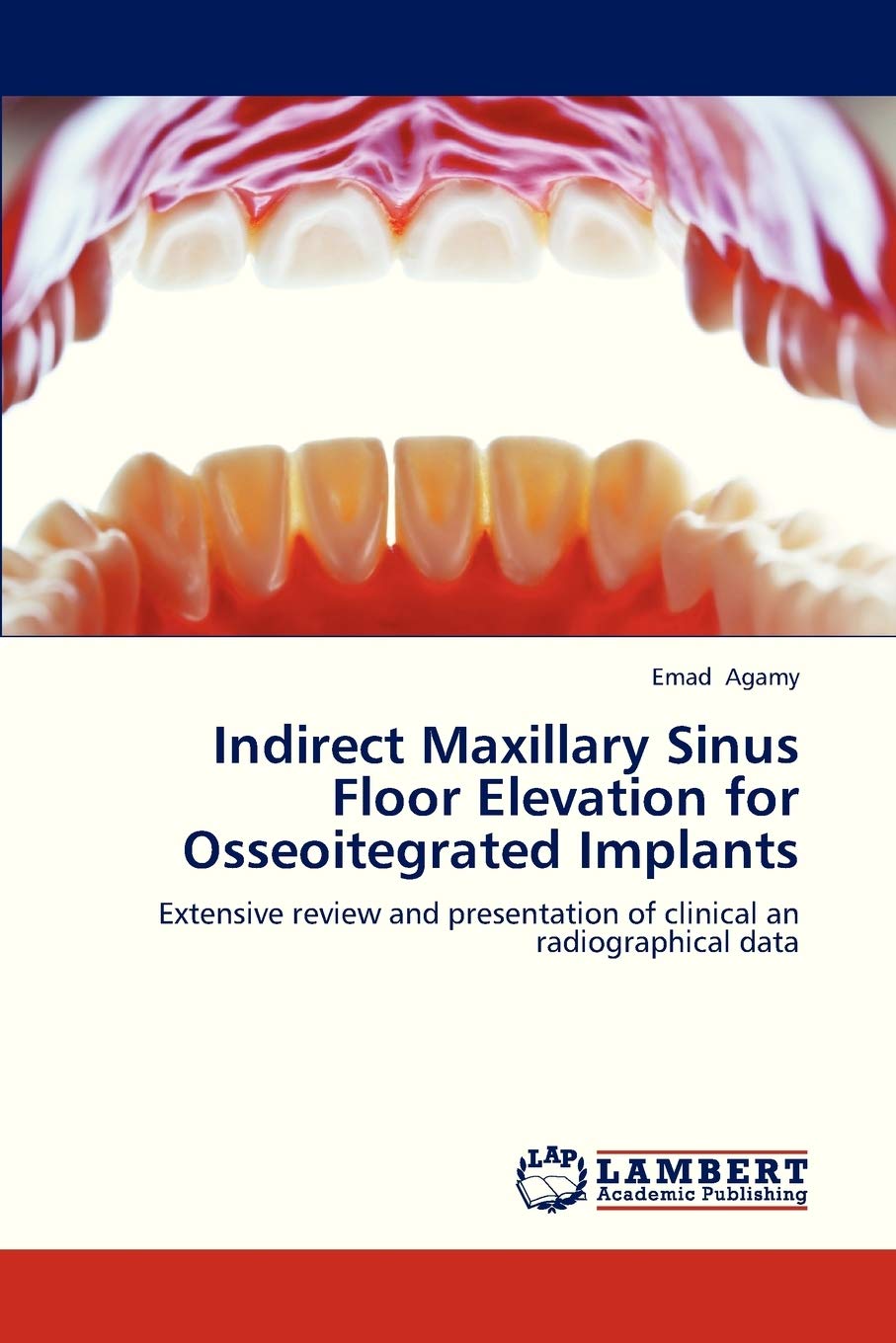 Indirect Maxillary Sinus Floor Elevation for Osseoitegrated Implants: Extensive review and presentation of clinical an radiograp,Used