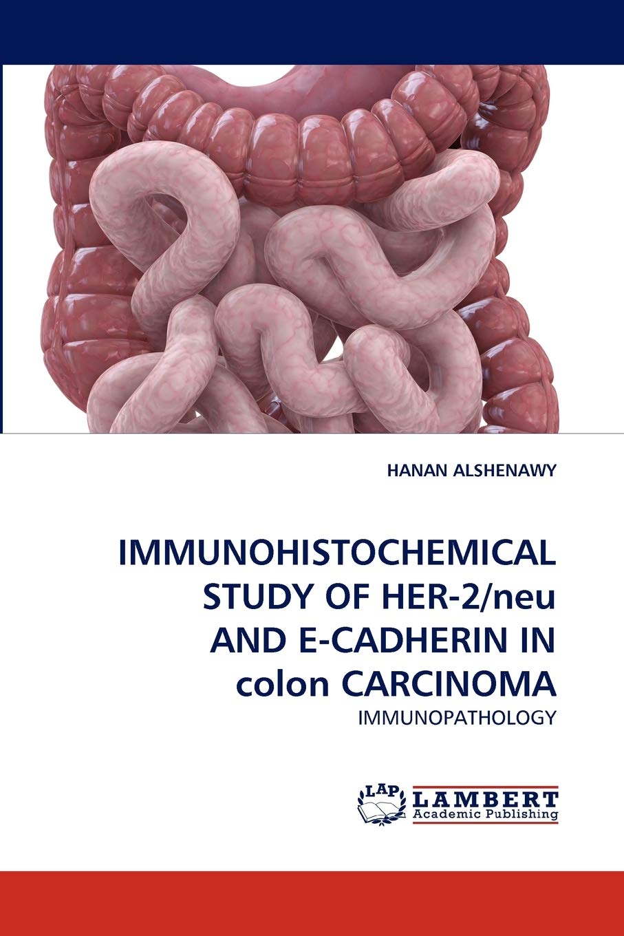 IMMUNOHISTOCHEMICAL STUDY OF HER2/neu AND ECADHERIN IN colon CARCINOMA: IMMUNOPATHOLOGY,Used