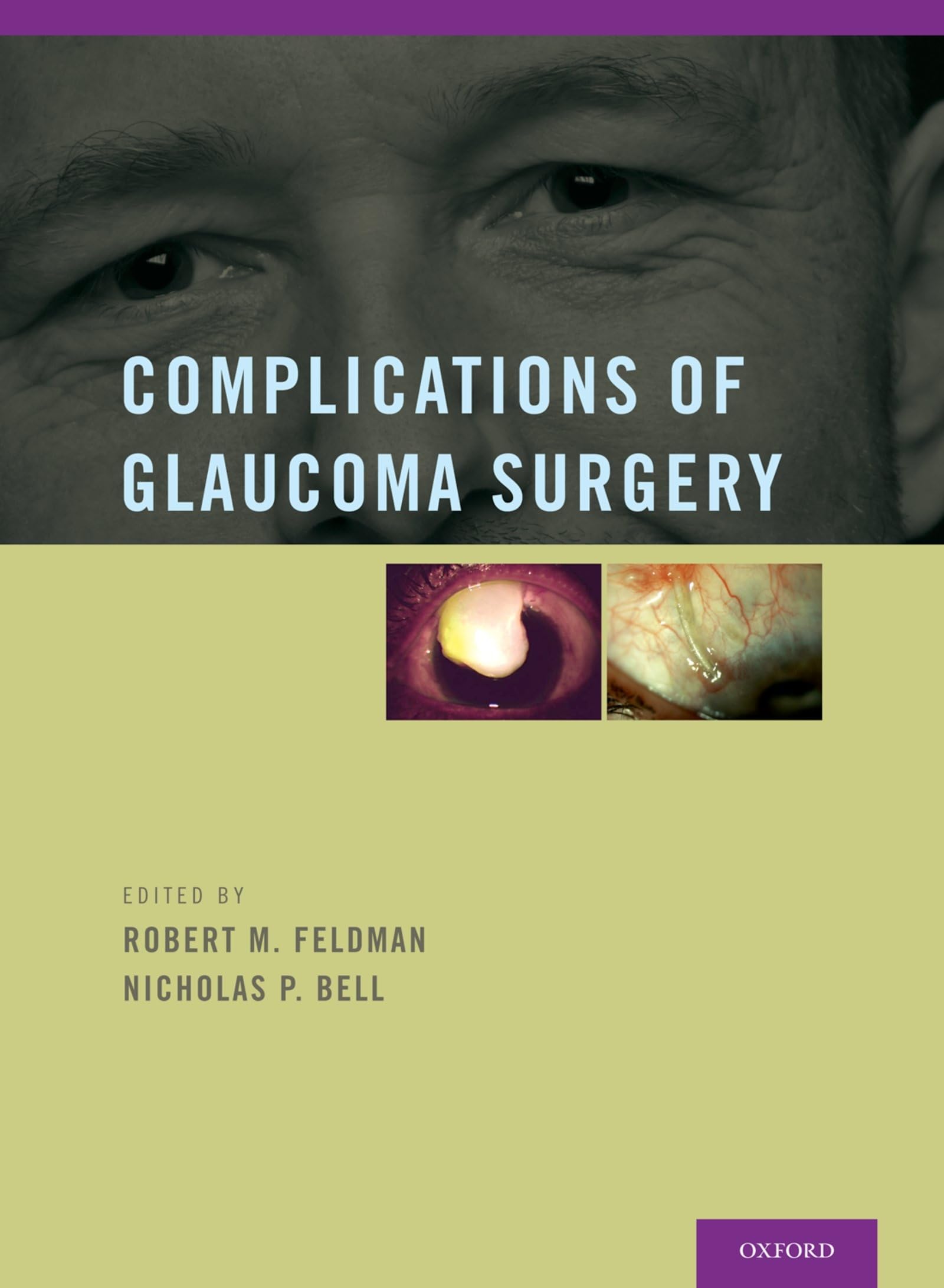 Complications of Glaucoma Surgery,Used
