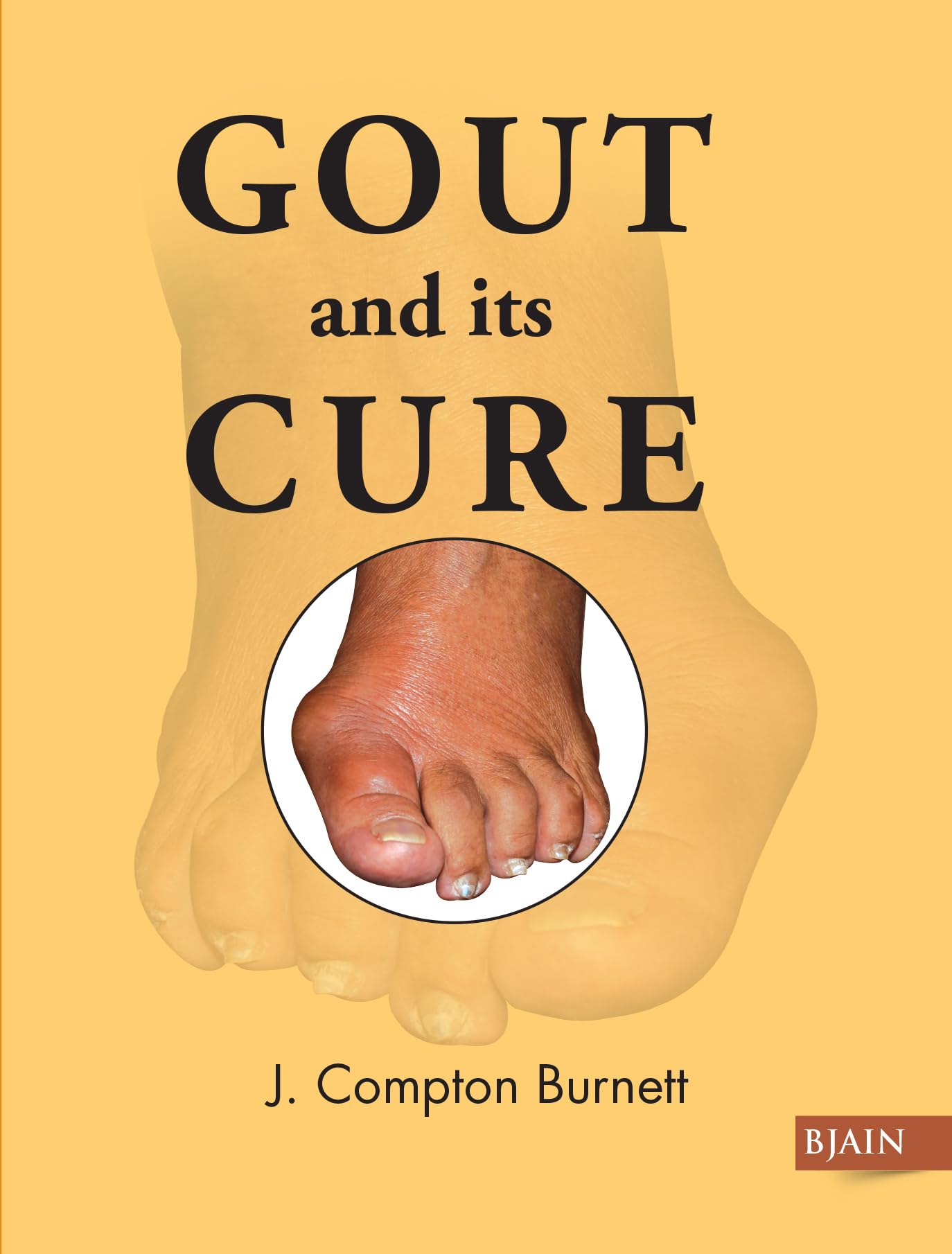 Gout & Its Cure