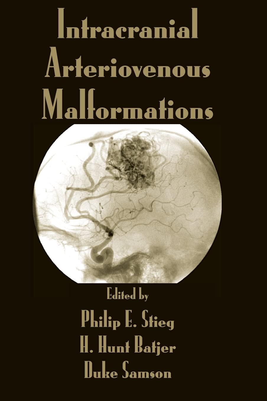 Intracranial Arteriovenous Malformations,Used