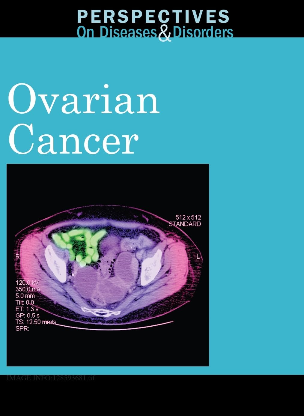 Ovarian Cancer (Perspectives On Diseases And Disorders),Used