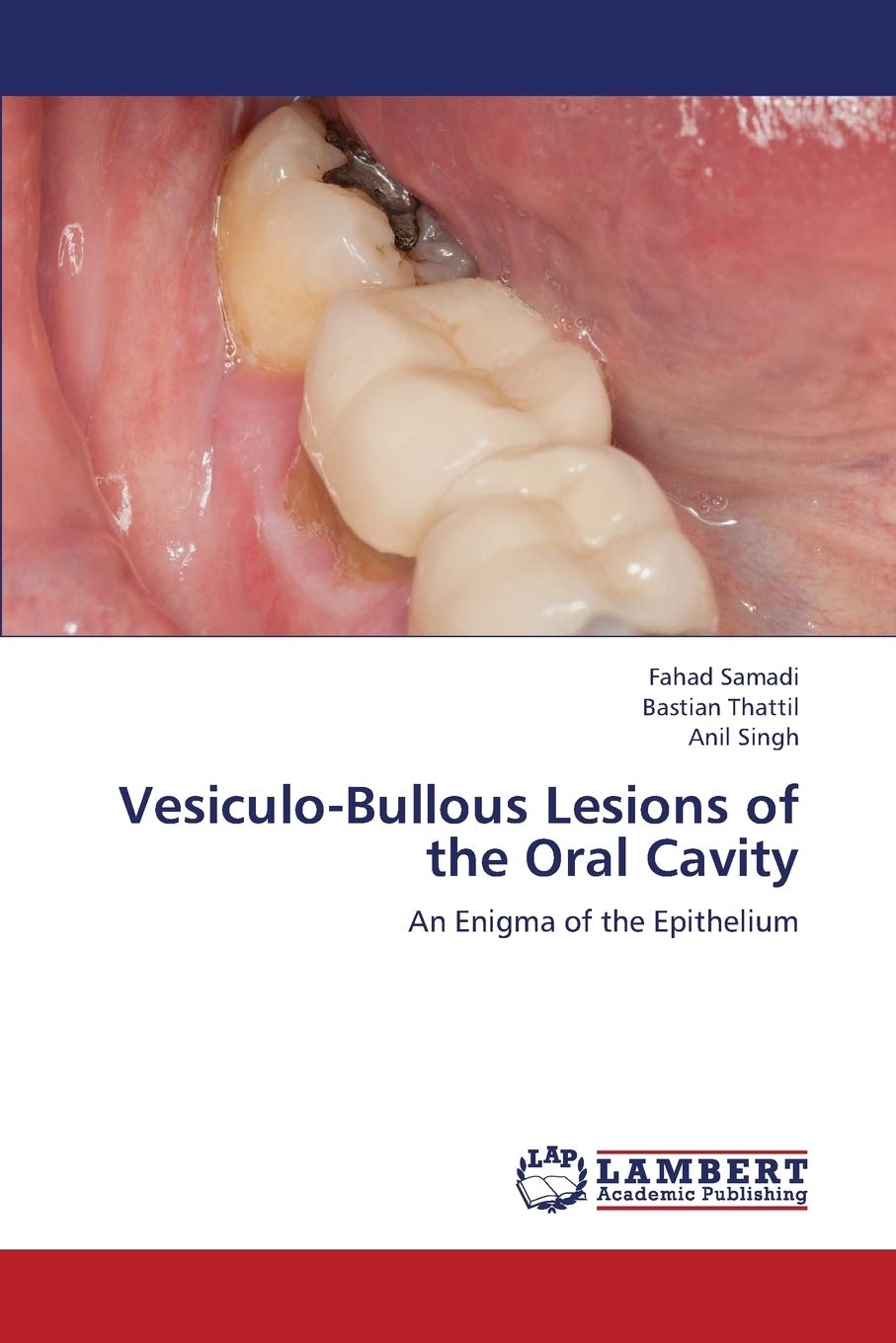 VesiculoBullous Lesions of the Oral Cavity: An Enigma of the Epithelium,Used