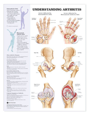 Understanding Arthritis Anatomical Chart,New